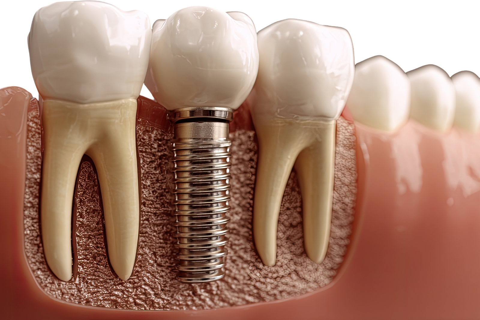 Impianti a carico immediato – denti fissi in 24 ore