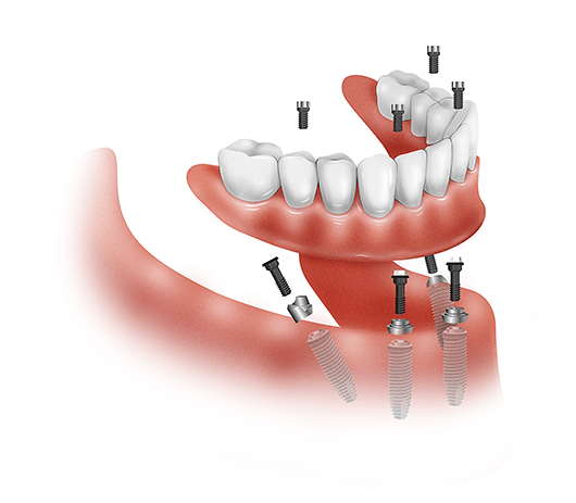 Denti Fissi in 24 Ore