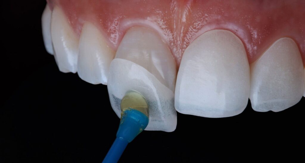 Faccette Dentali Brindisi