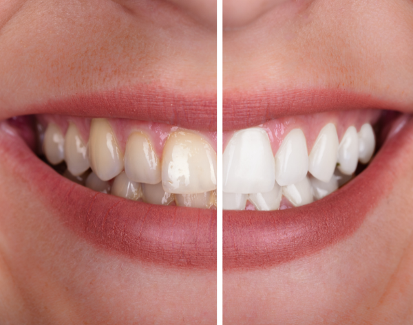 Sbiancamento denti