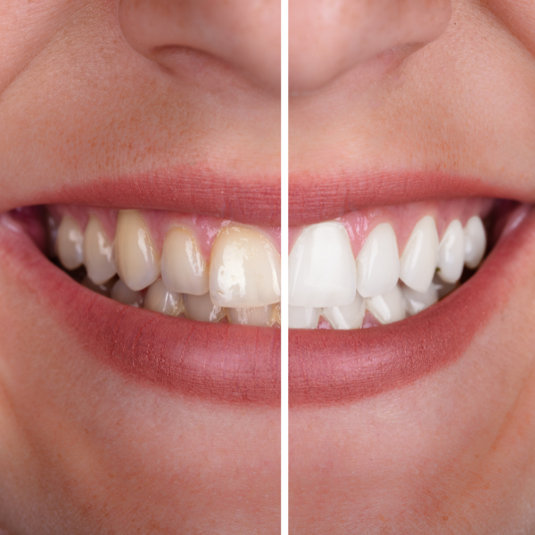 Sbiancamento denti