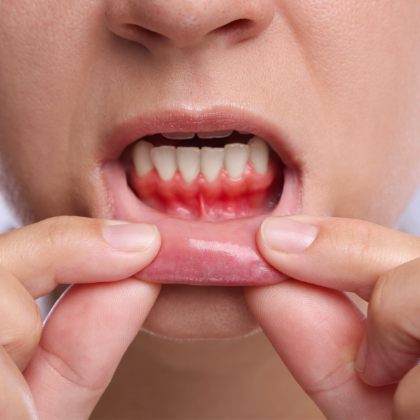 gengive che sanguinano