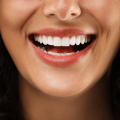 Faccette dentali: pro e contro reali (guida completa a Brindisi)
