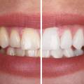 Denti gialli: cause e soluzioni efficaci