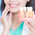 Cosa valutare prima di un impianto dentale