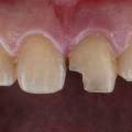 Dente scheggiato o rotto: cosa fare subito