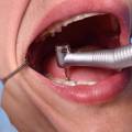 Denti gialli: cause e soluzioni efficaci