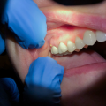 Ascesso dentale: sintomi, cosa fare e perché non va ignorato