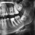 Dente del giudizio a Brindisi: quando è necessario estrarlo?